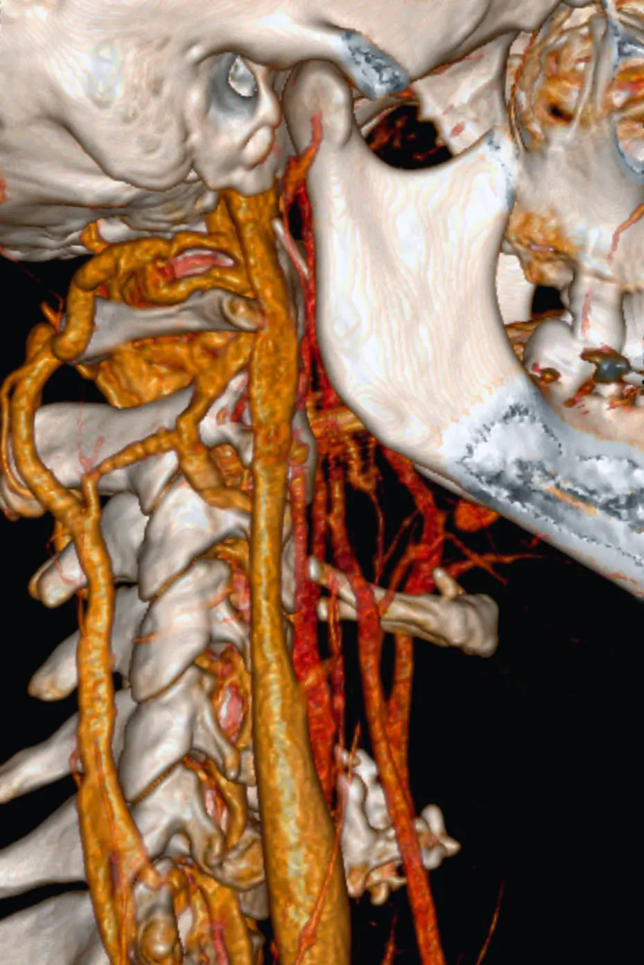 Angiografía TC cervical