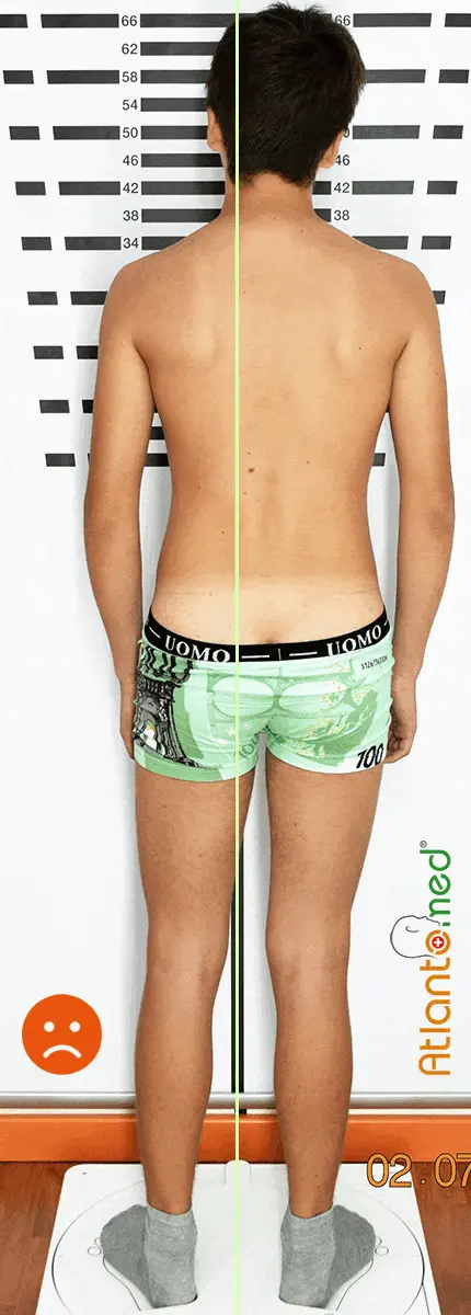 Inclinación de la pelvis - asimetría /oblicuidad de la pelvis