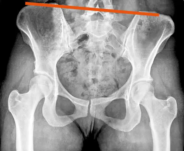 Radiografía de pelvis inclinada