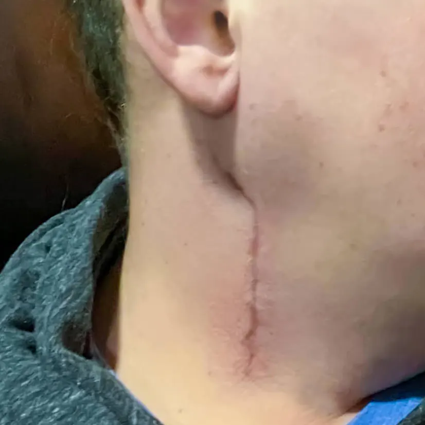 Cirugía y rectificación de la columna cervical