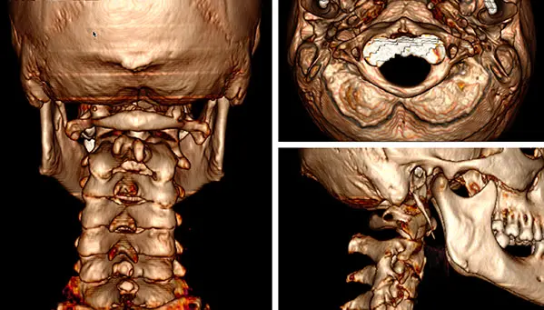 Tomografía cervical