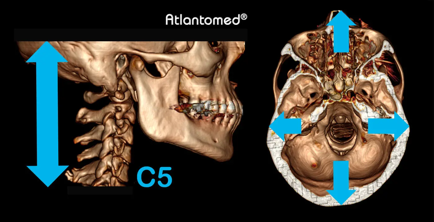 TC espiral del cráneo y cervical con Atlas y Epistrofeo