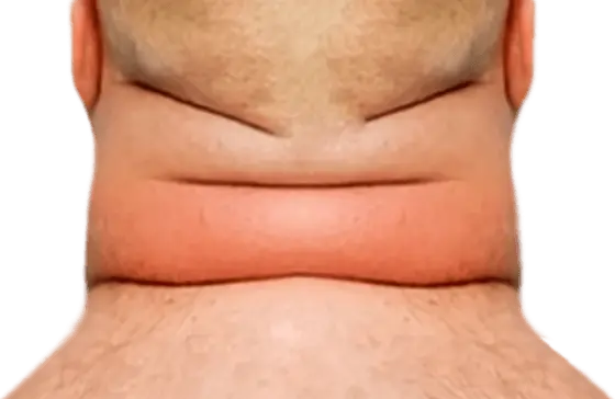 Cuello taurino