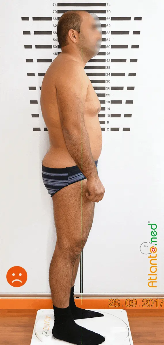 Cambio postural después del realineamiento del Atlas
