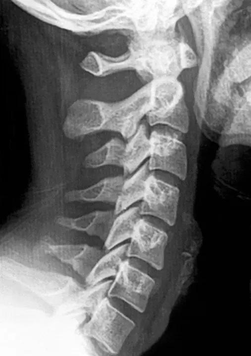 Verticalización de la columna cervical después de un latigazo cervical