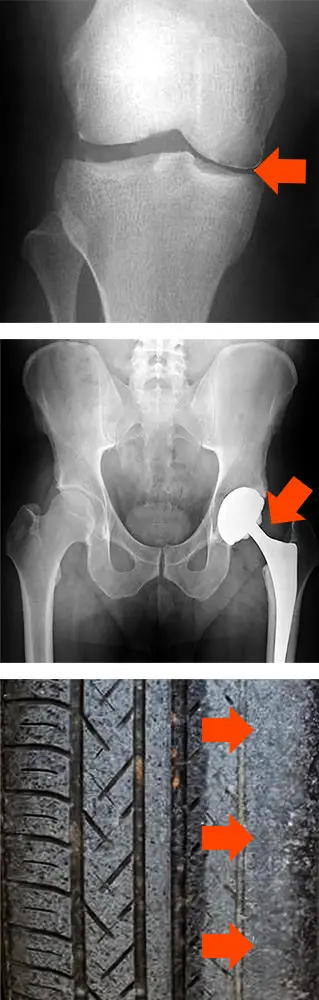 Dolor en la cadera y en las rodillas causado por articulaciones degeneradas