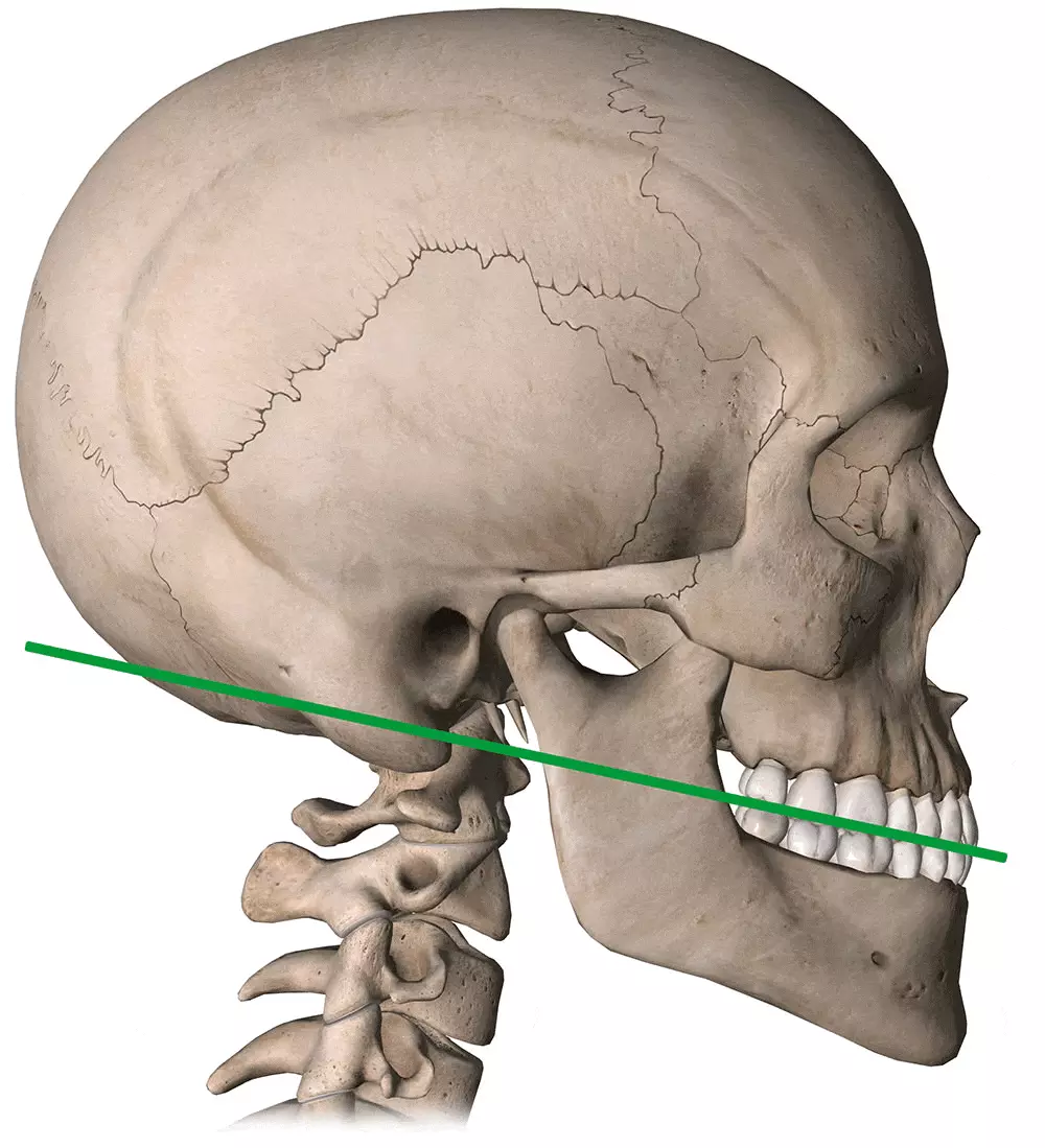Rectificación de la columna cervical y mandíbula desviada