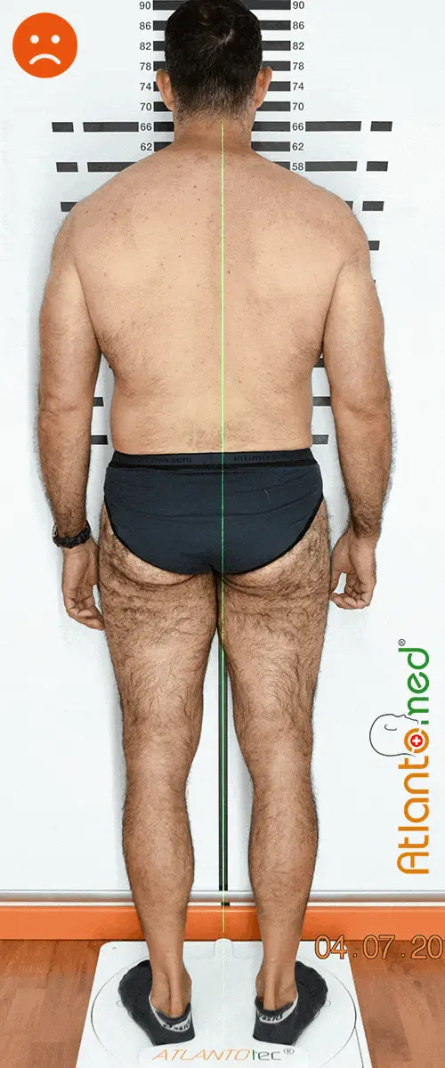 Pelvis inclinada antes y después