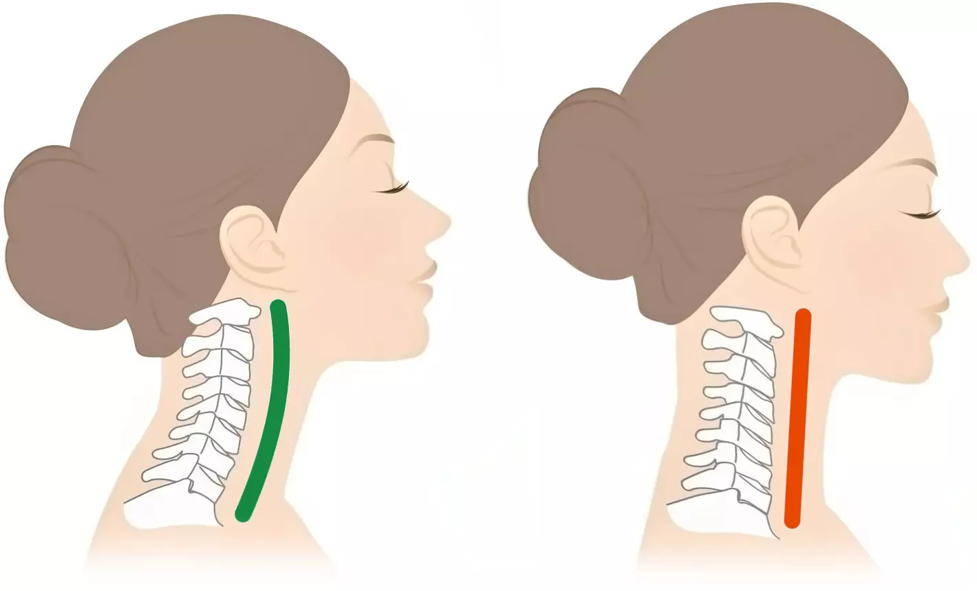Rectificación de la columna cervical