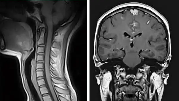 Resonancia magnética cervical