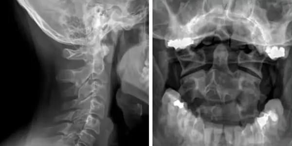 Radiografía cervical e intraoral
