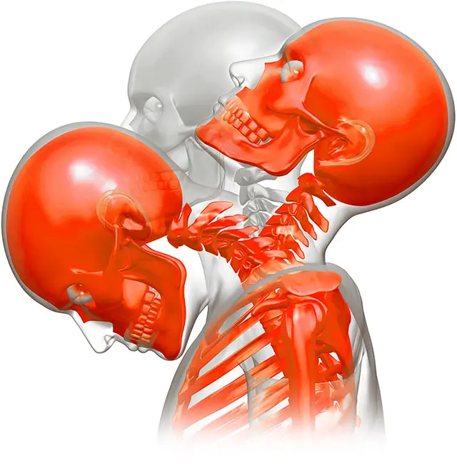 Movimiento de la cabeza durante un latigazo cervical