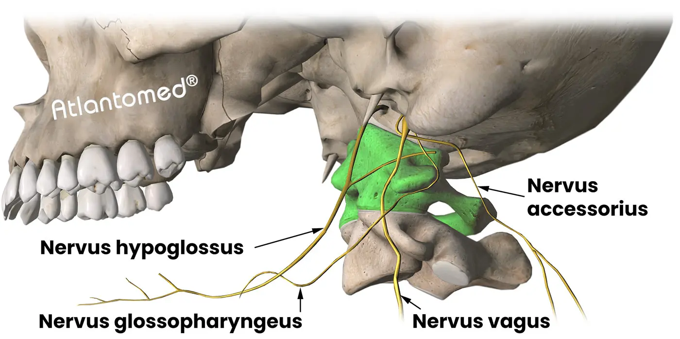 Nervio accesorio, nervio glosofaríngeo, nervio vago, nervio hipogloso y desalineamiento del Atlas